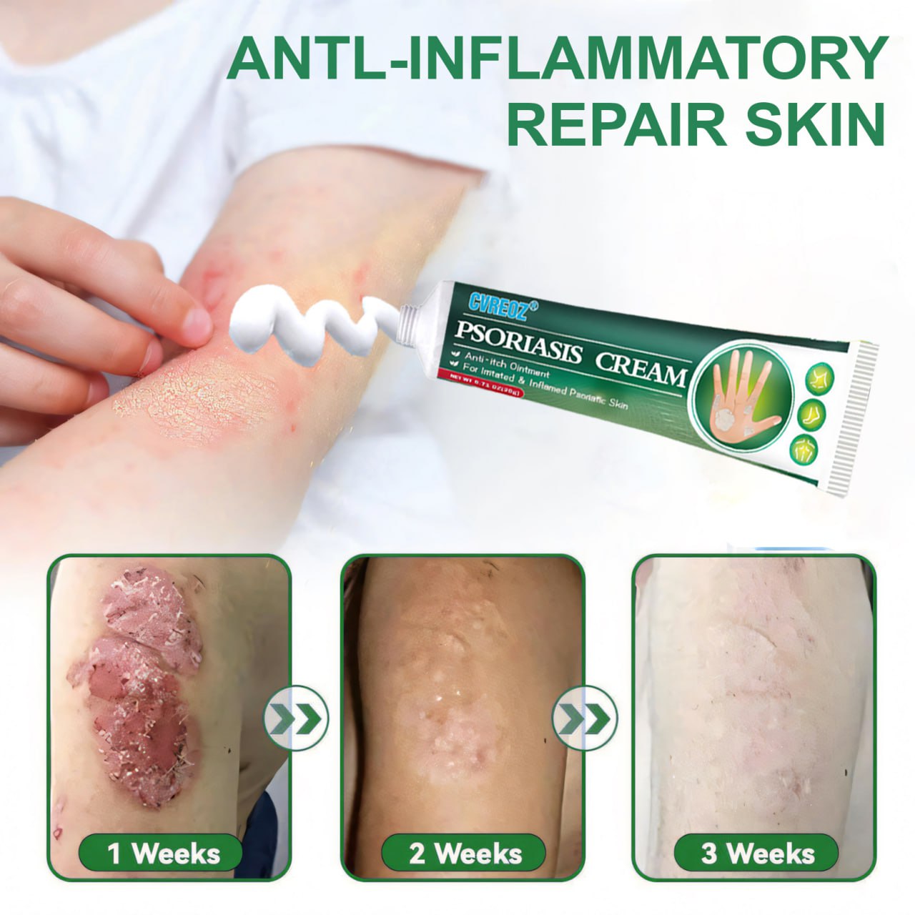 Cvreoz® Knotaway Psoriasis Cream🔥LIMITED SALE: 60% OFF🔥