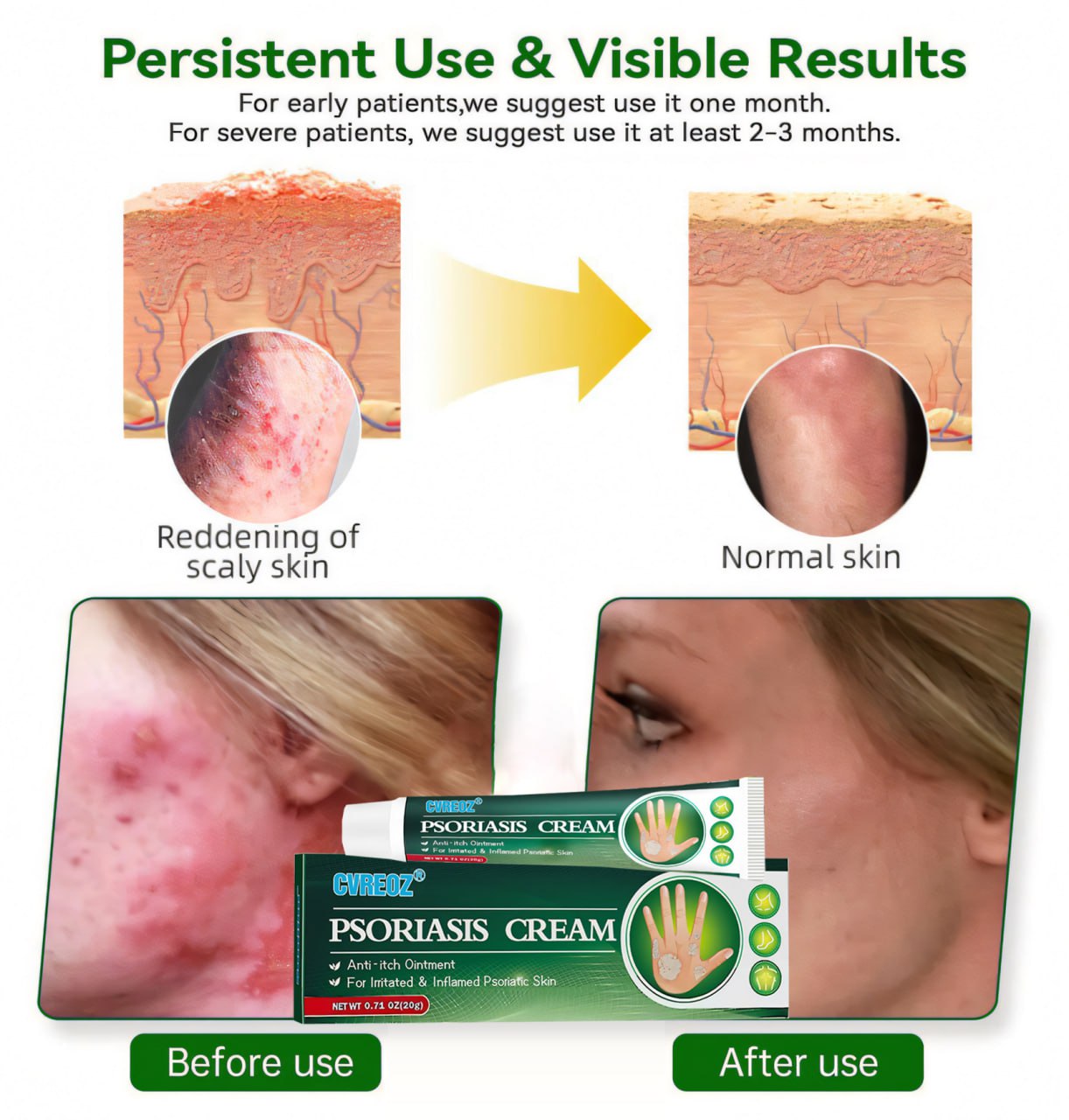 Cvreoz® Knotaway Psoriasis Cream🔥LIMITED SALE: 60% OFF🔥