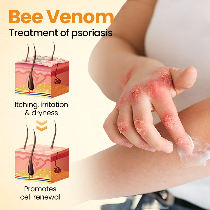 ⏰Last Day Promotion: 60% OFF🔥 Cvreoz® BeeLief Psoriasis Skin Care Cream