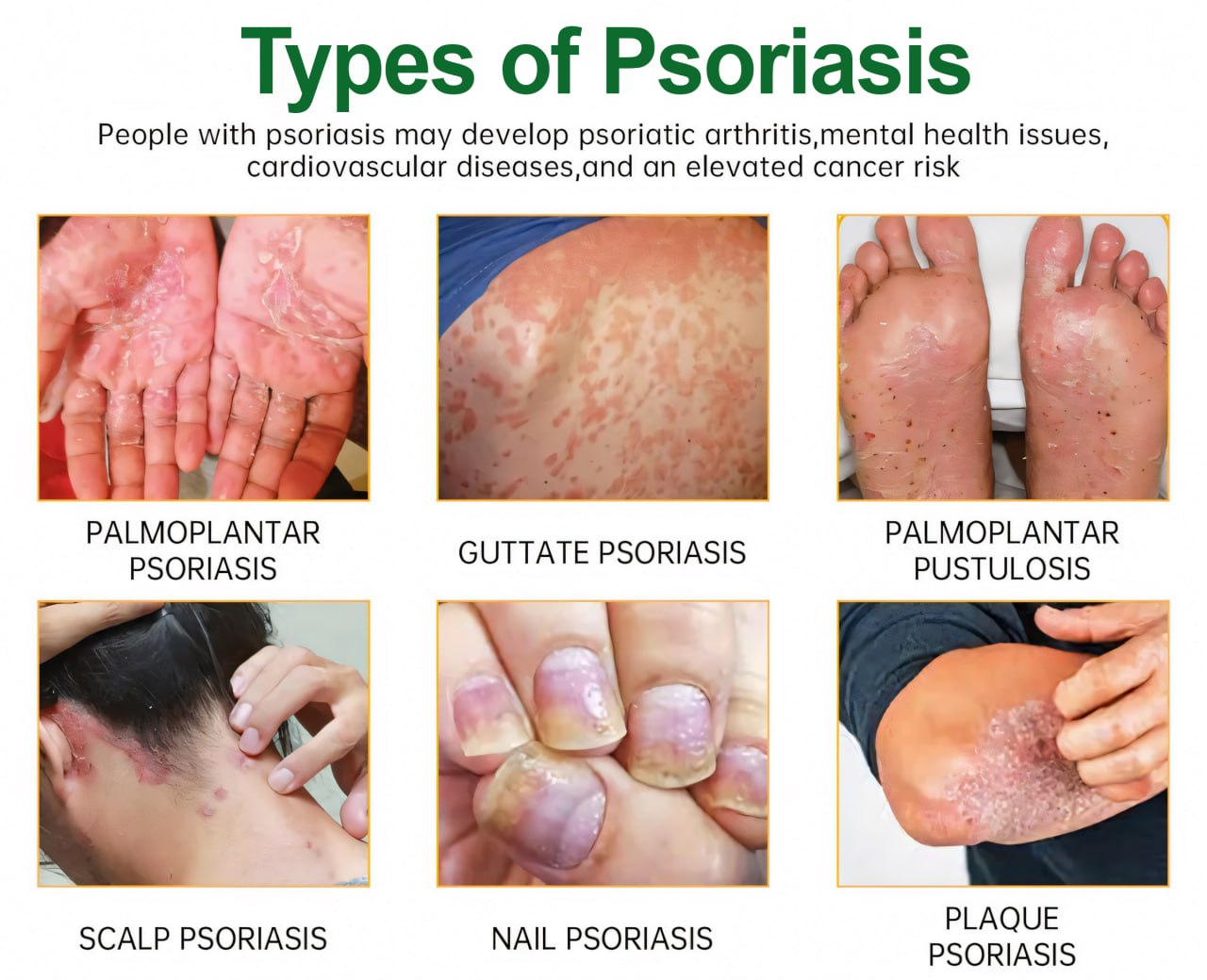 Cvreoz® Knotaway Psoriasis Cream🔥LIMITED SALE: 60% OFF🔥