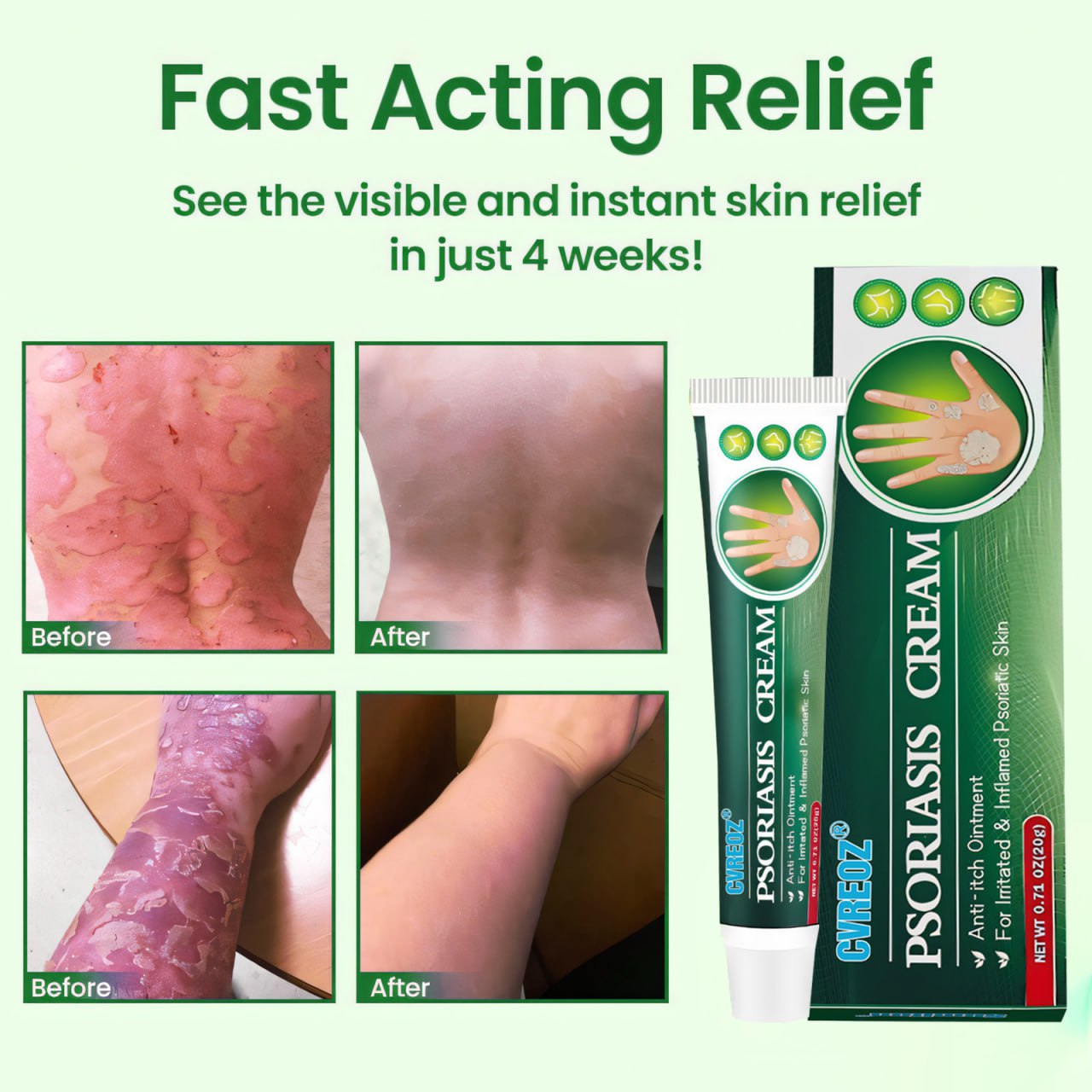 Cvreoz® Knotaway Psoriasis Cream🔥LIMITED SALE: 60% OFF🔥