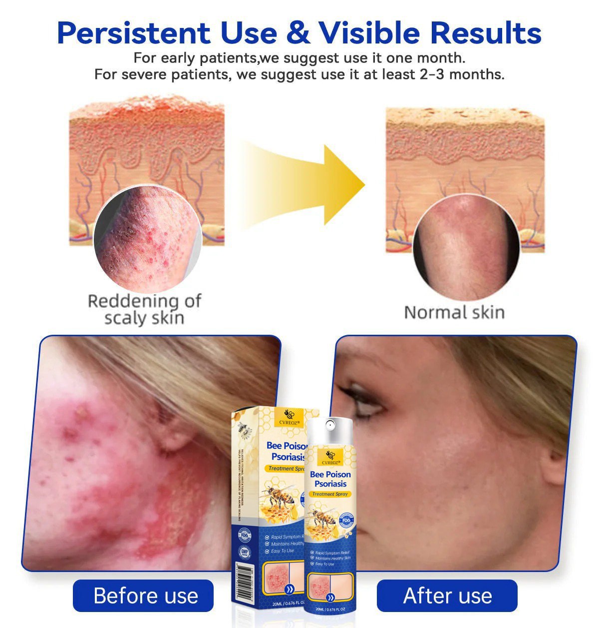 ⭐ CVREOZ® Bee Poison Psoriasis Treatment Spray 🐝 LIMITED OFFER 60% OFF 💛