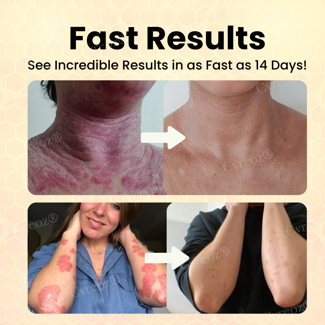 đ LIMITED OFFER 60% OFF đ CvreozÂź Bee Venom Psoriasis Cream