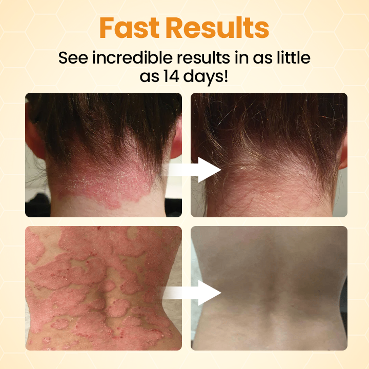 ⏰Last Day Promotion: 60% OFF🔥 Cvreoz® BeeLief Psoriasis Skin Care Cream