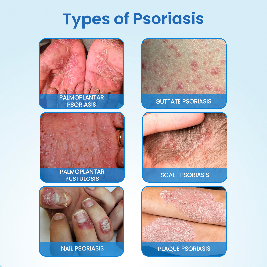 Cvreoz® MagnesiumHerb Psoriasis Relief Cream