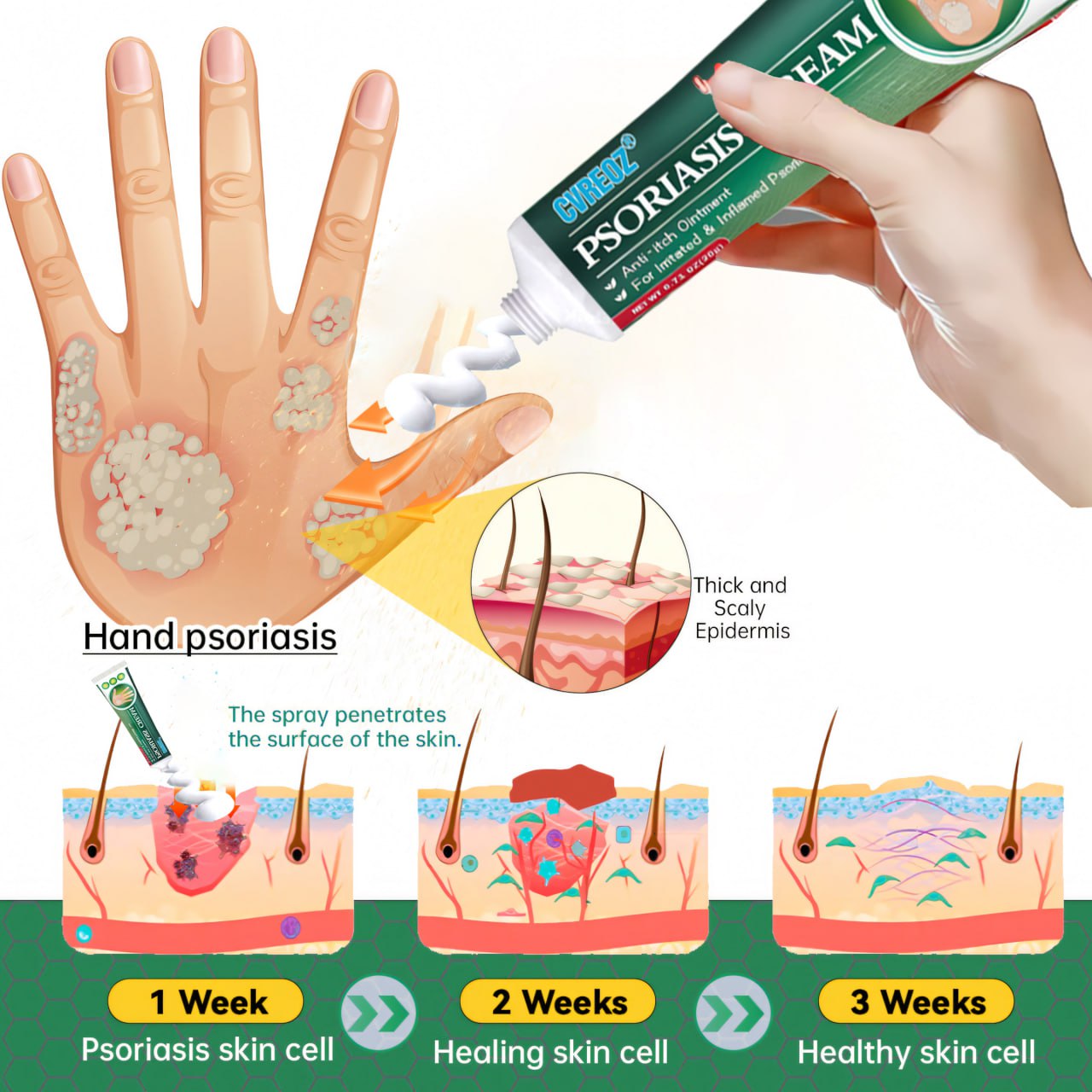 Cvreoz® Knotaway Psoriasis Cream🔥LIMITED SALE: 60% OFF🔥