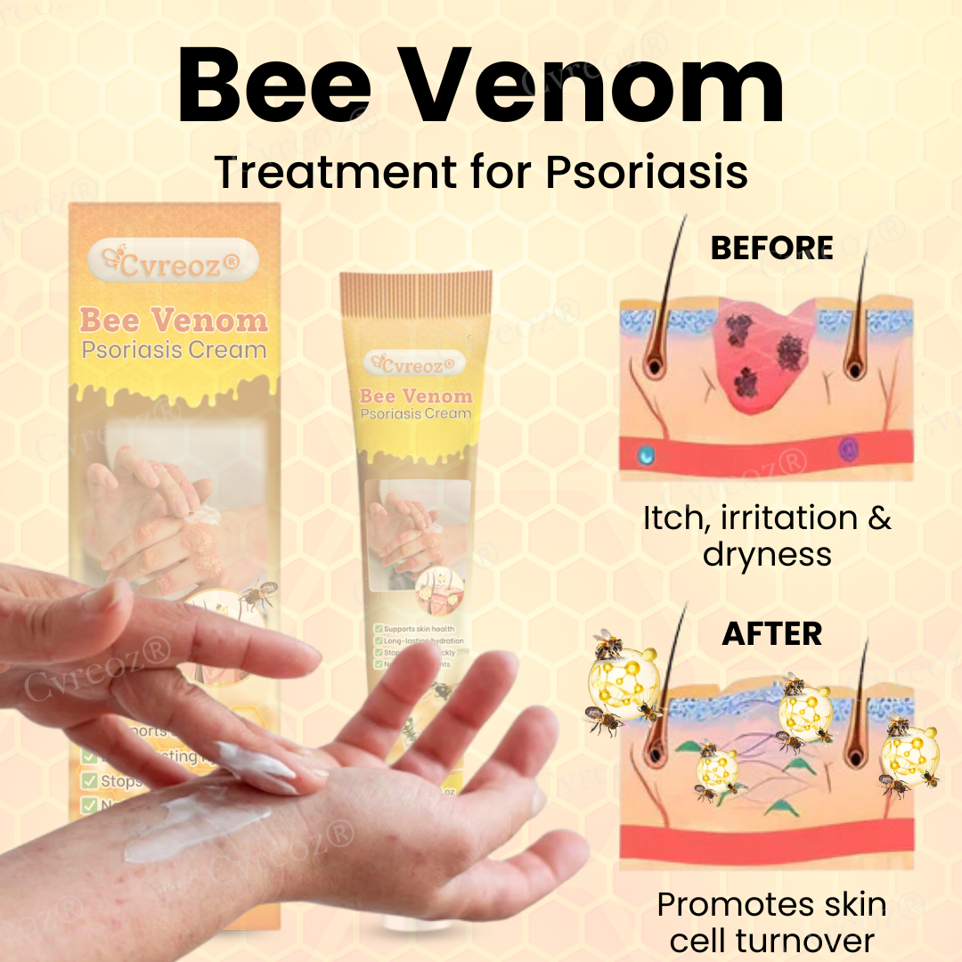 đ LIMITED OFFER 60% OFF đ CvreozÂź Bee Venom Psoriasis Cream