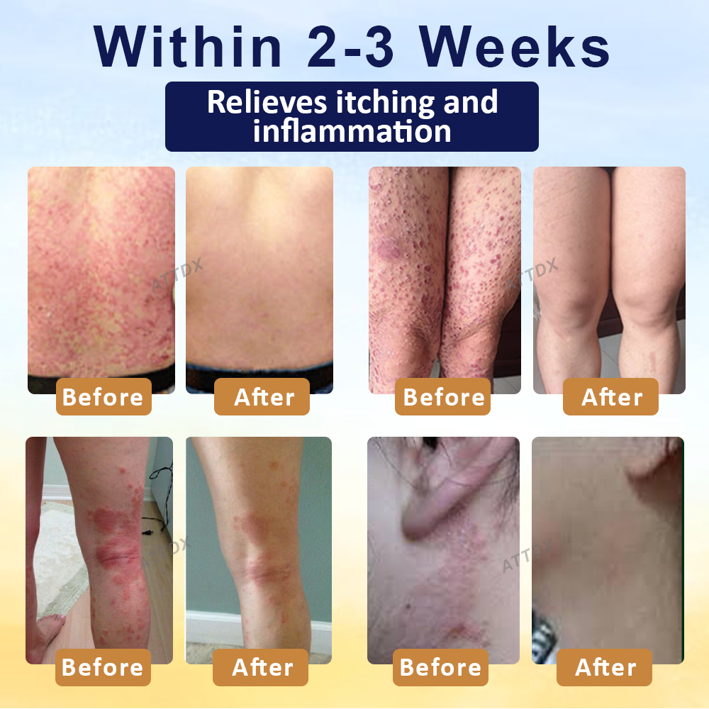 Cvreoz® PsoriasisCare Mellifera Venom Skin Healing Spray🔥