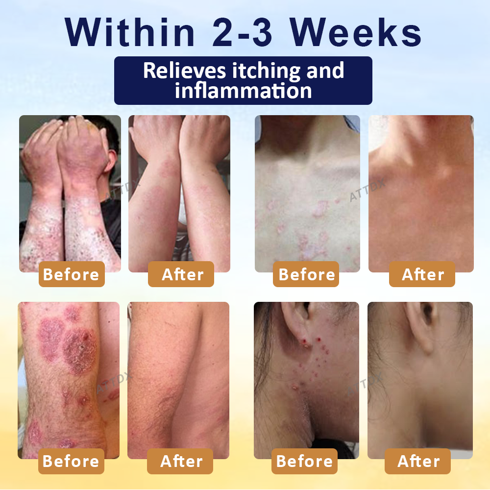 Cvreoz® PsoriasisCare Mellifera Venom Skin Healing Spray🔥
