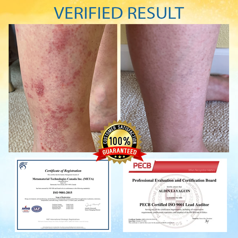 Cvreoz® PsoriasisCare Mellifera Venom Skin Healing Spray🔥