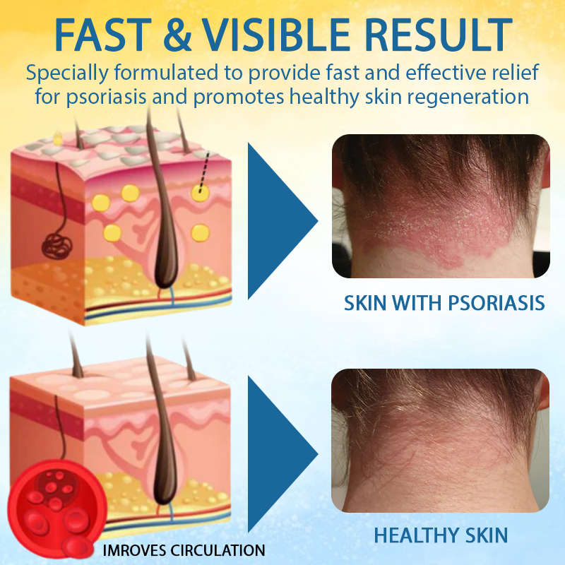 Cvreoz® PsoriasisCare Mellifera Venom Skin Healing Spray🔥