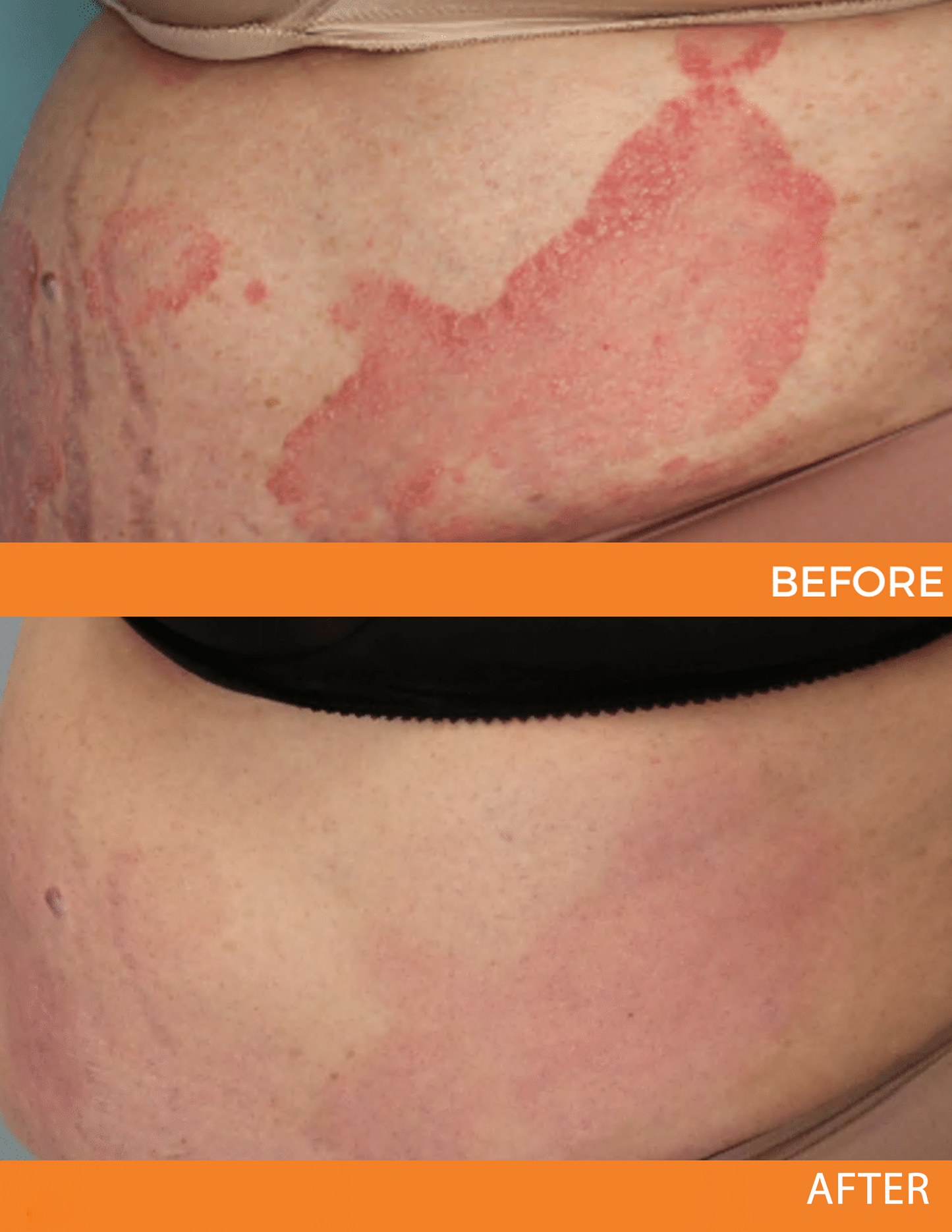 🐝 LIMITED OFFER 60% OFF 💛 Cvreoz® Bee Venom Psoriasis Relief Spray