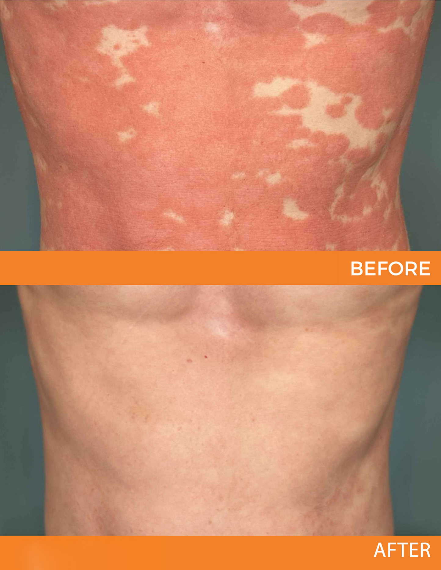 🐝 LIMITED OFFER 60% OFF 💛 Cvreoz® Bee Venom Psoriasis Relief Spray