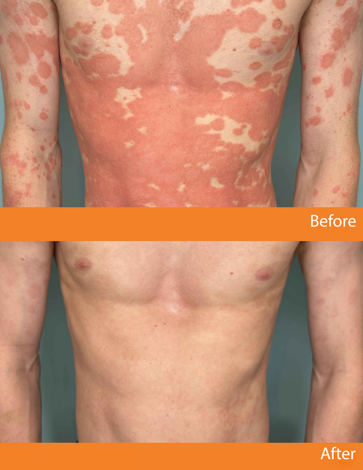 đ LIMITED OFFER 60% OFF đ CvreozÂź Psoriasis Bee Venom Care Spray