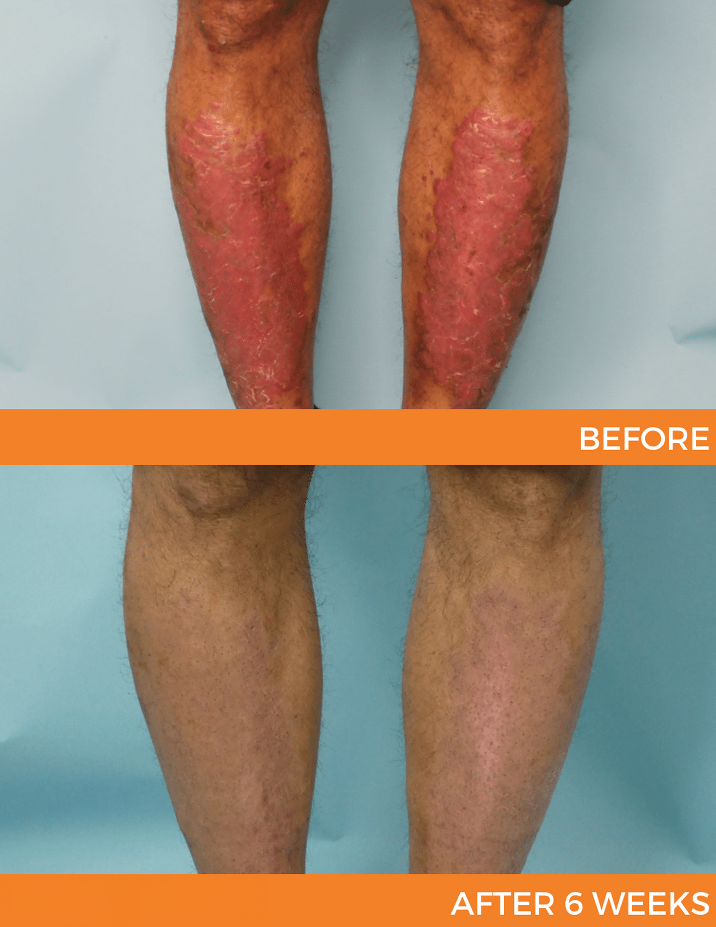 đ LIMITED OFFER 60% OFF đ CvreozÂź Psoriasis Bee Venom Care Spray