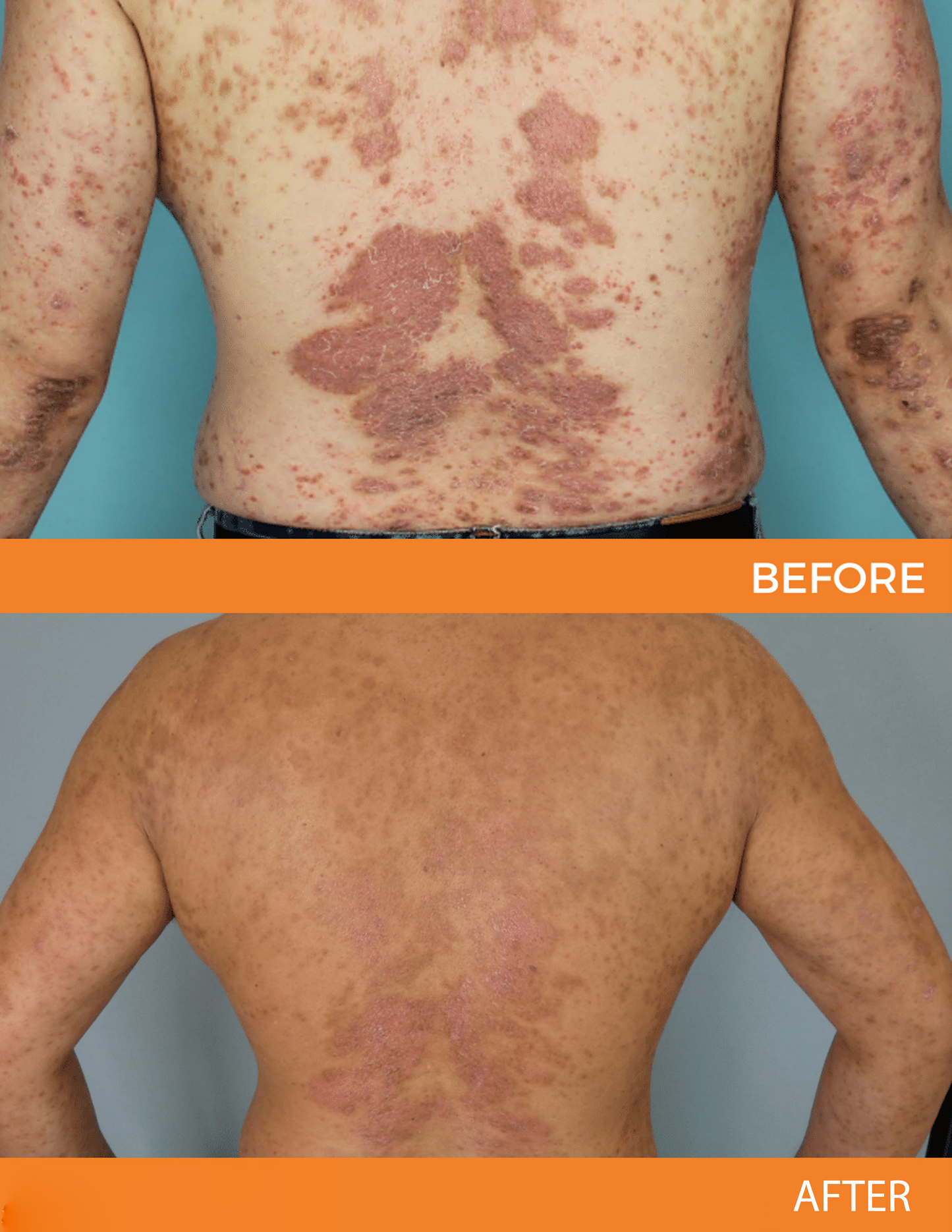 đ LIMITED OFFER 60% OFF đ CvreozÂź Psoriasis Bee Venom Care Spray