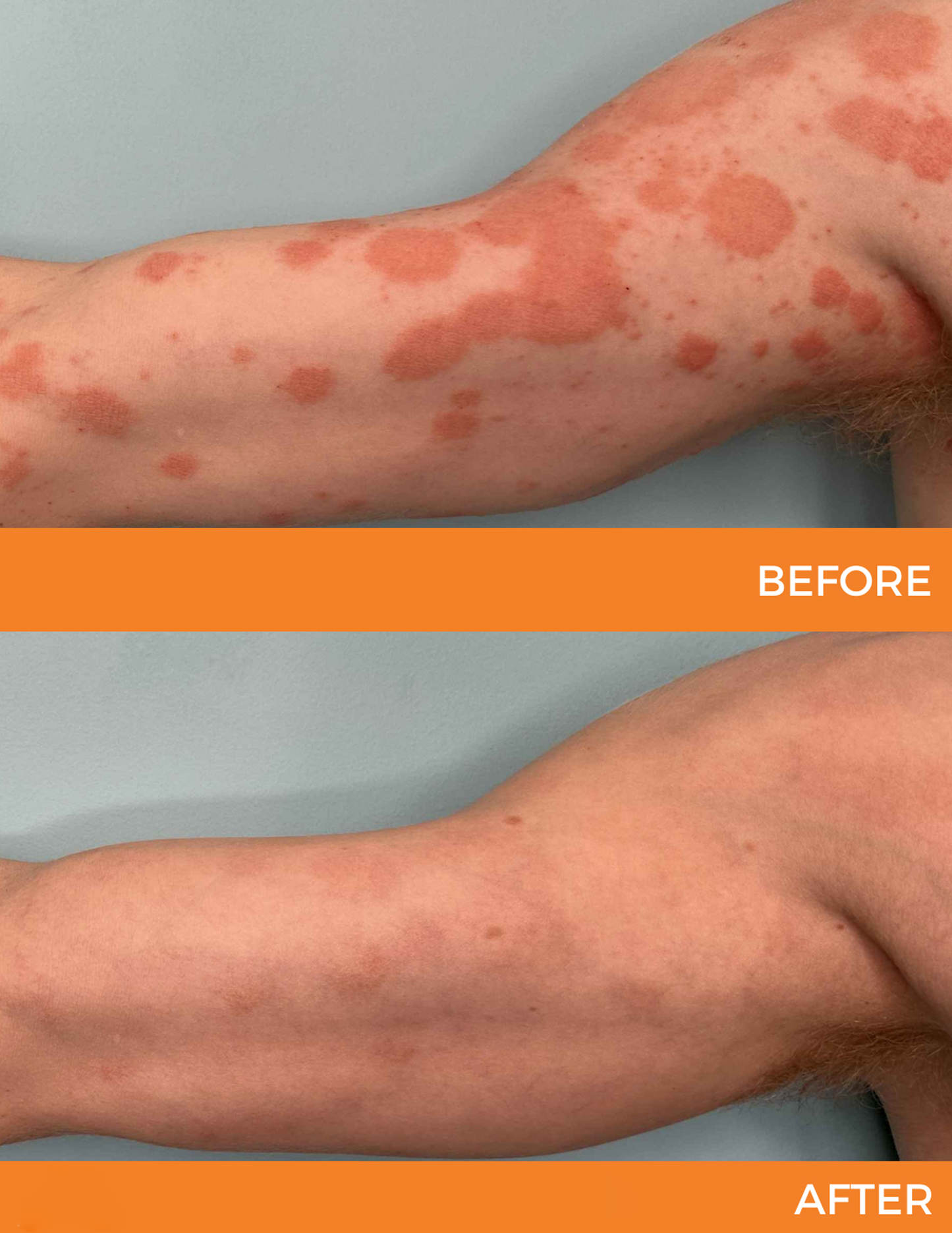 🐝 LIMITED OFFER 60% OFF 💛 Cvreoz® Bee Venom Psoriasis Relief Spray