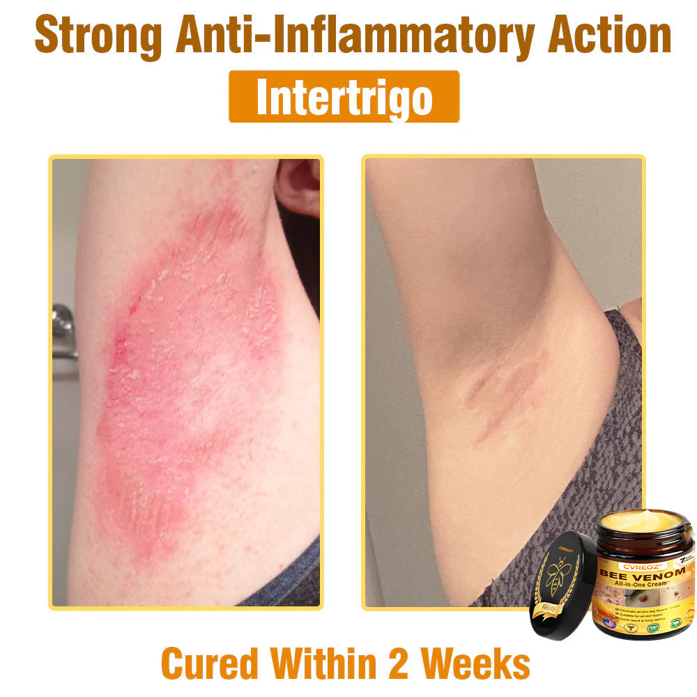 ⏰Last Day Promotion: 60% OFF🔥Cvreoz® Bee Venom All-in-One Cream