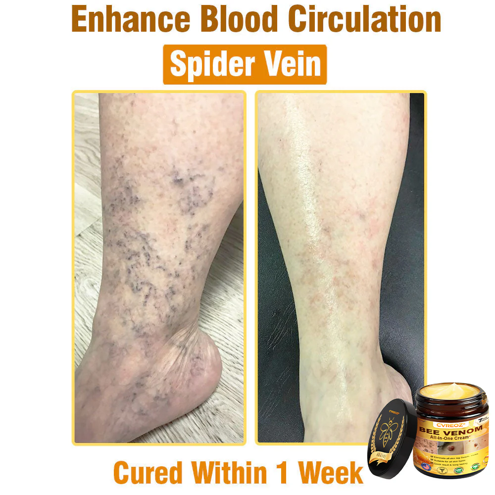 ⏰Last Day Promotion: 60% OFF🔥Cvreoz® Bee Venom All-in-One Cream