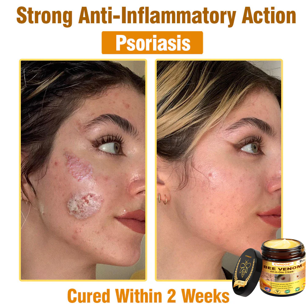 ⏰Last Day Promotion: 60% OFF🔥Cvreoz® Bee Venom All-in-One Cream