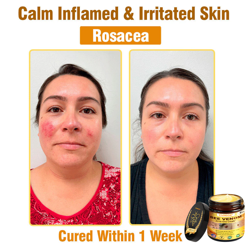 ⏰Last Day Promotion: 60% OFF🔥Cvreoz® Bee Venom All-in-One Cream