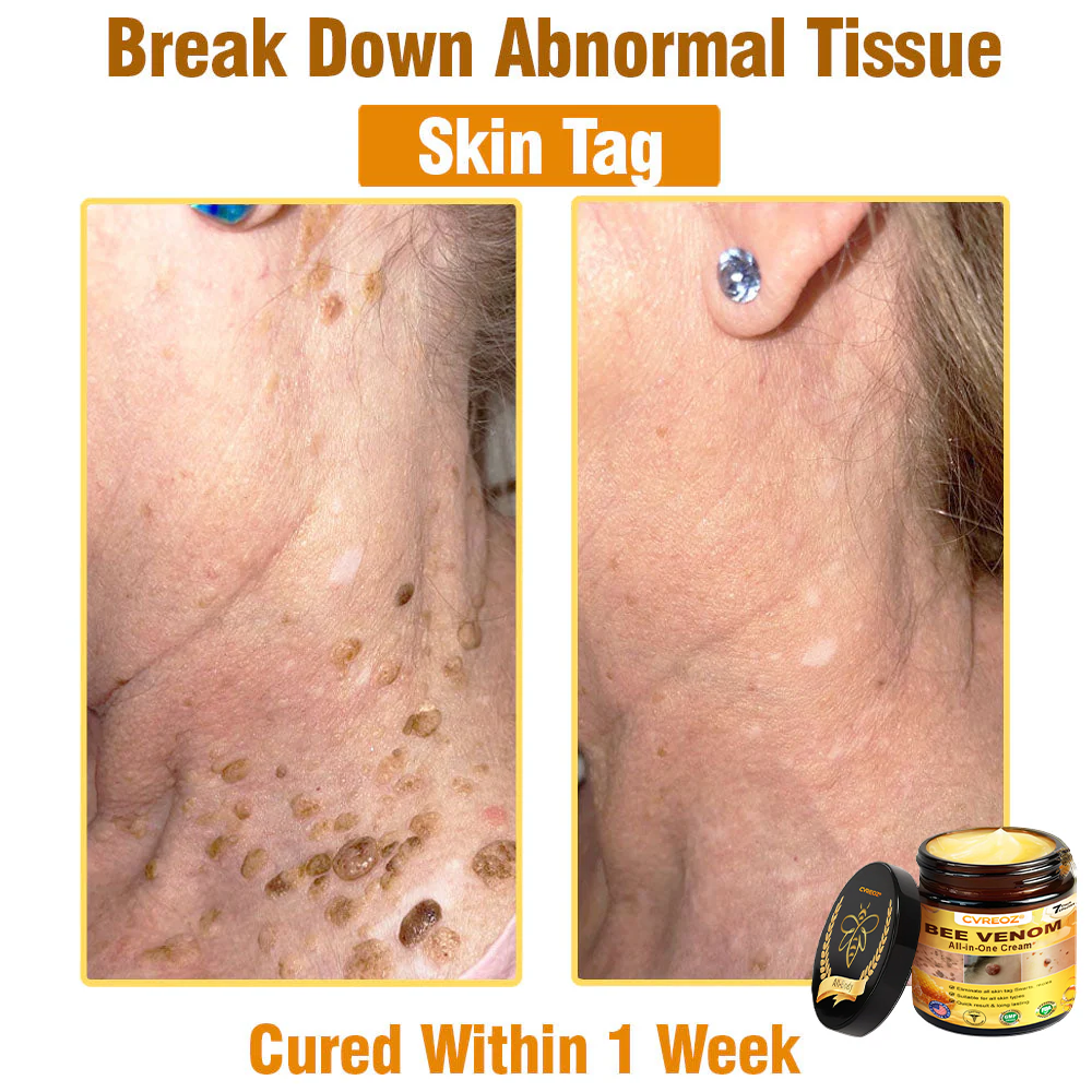 ⏰Last Day Promotion: 60% OFF🔥Cvreoz® Bee Venom All-in-One Cream
