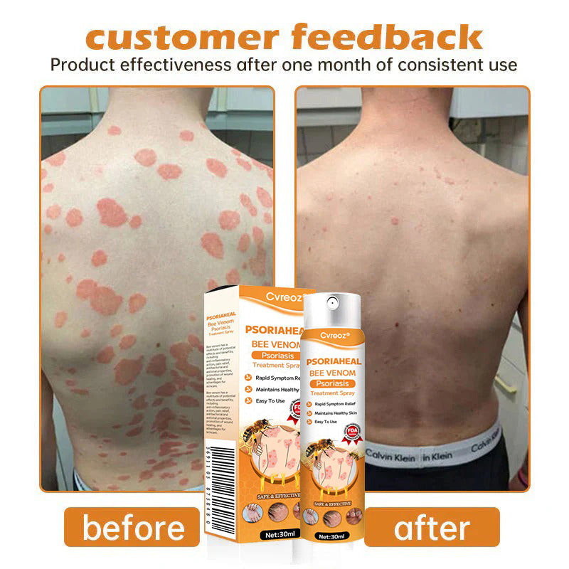 ⏰Last Day Promotion: 60% OFF🔥 Cvreoz® PsoriaHeal Bee Venom Psoriasis Treatment Spray