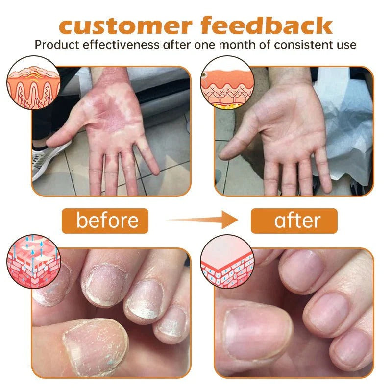 ⏰Last Day Promotion: 60% OFF🔥 Cvreoz® PsoriaHeal Bee Venom Psoriasis Treatment Spray