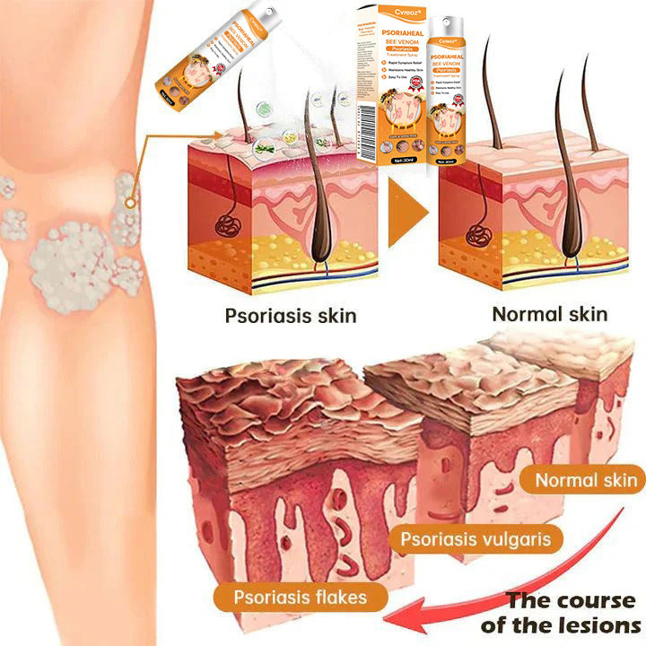 ⏰Last Day Promotion: 60% OFF🔥 Cvreoz® PsoriaHeal Bee Venom Psoriasis Treatment Spray