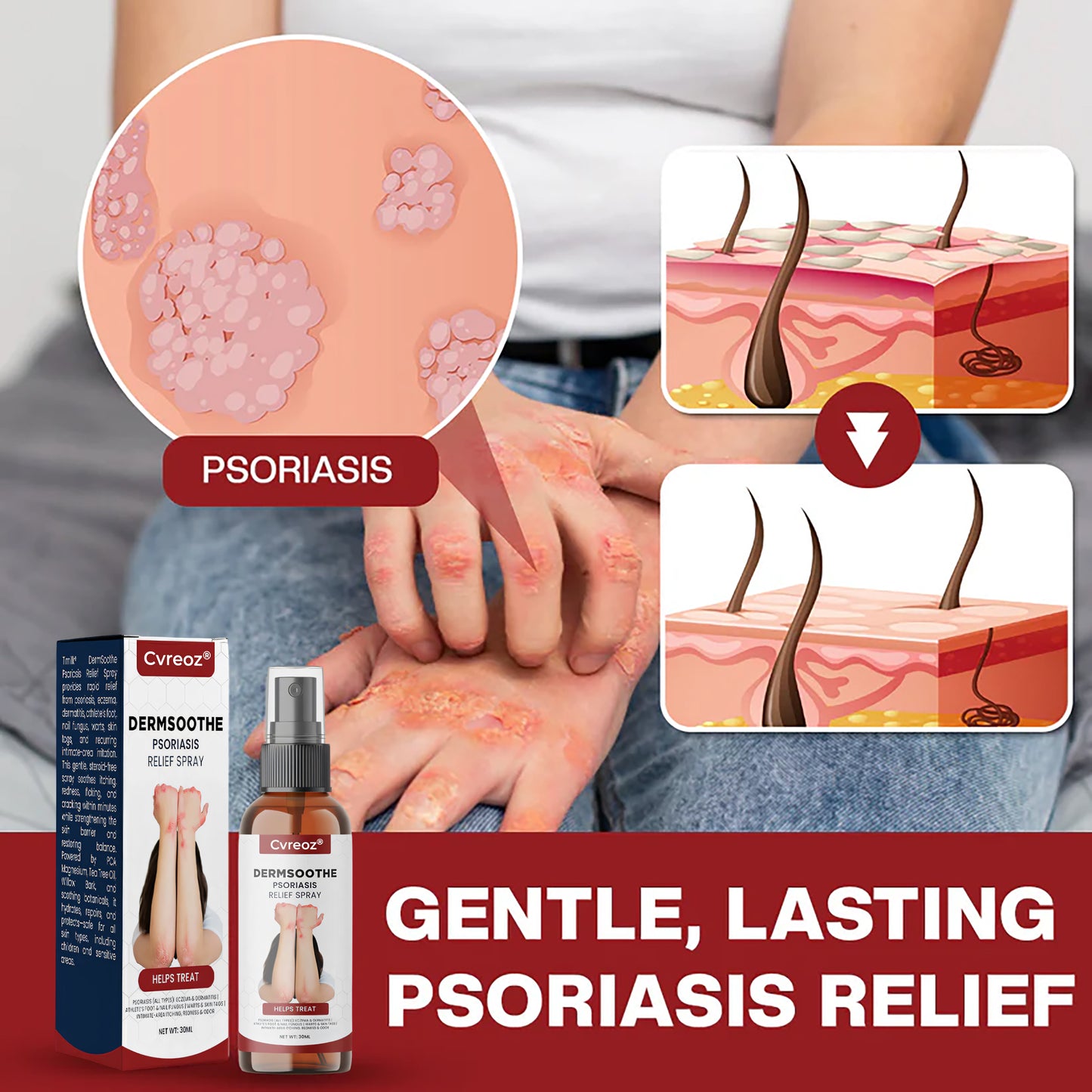 Cvreoz® DermSoothe Psoriasis Relief Spray —Clinically Tested, FDA-Recognized Formula