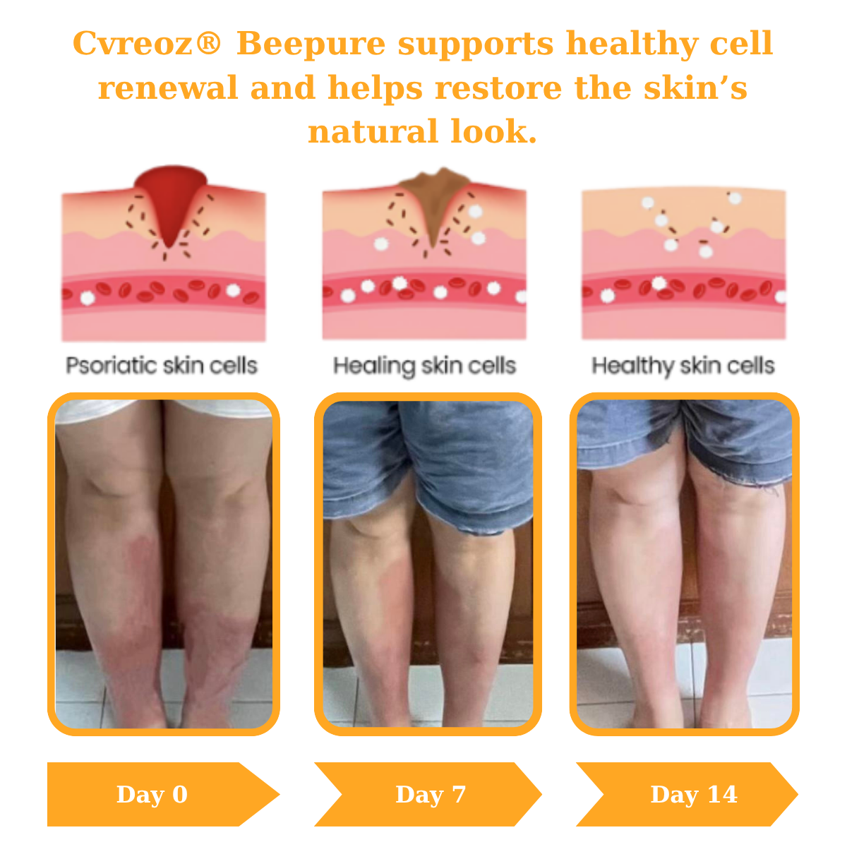 đ„ 60% OFF â CvreozÂź Beepure psoriasis Skin Care