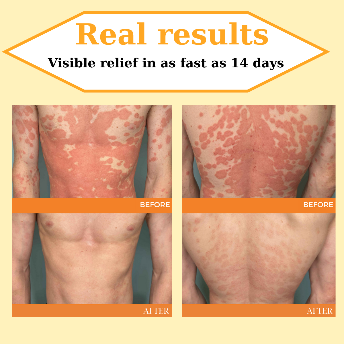đ„ 60% OFF â CvreozÂź Beepure psoriasis Skin Care