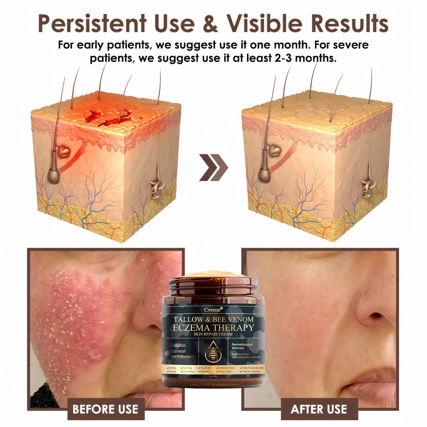 ⚡Final Chance: Save 60% Today Only🔥Cvreoz® Tallow & Bee Venom Eczema Theraphy
