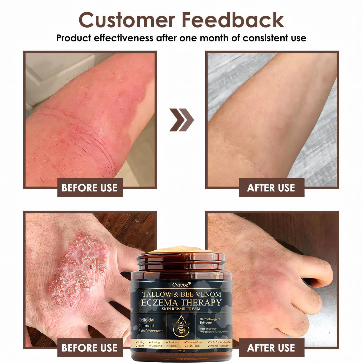 ⚡Final Chance: Save 60% Today Only🔥Cvreoz® Tallow & Bee Venom Eczema Theraphy