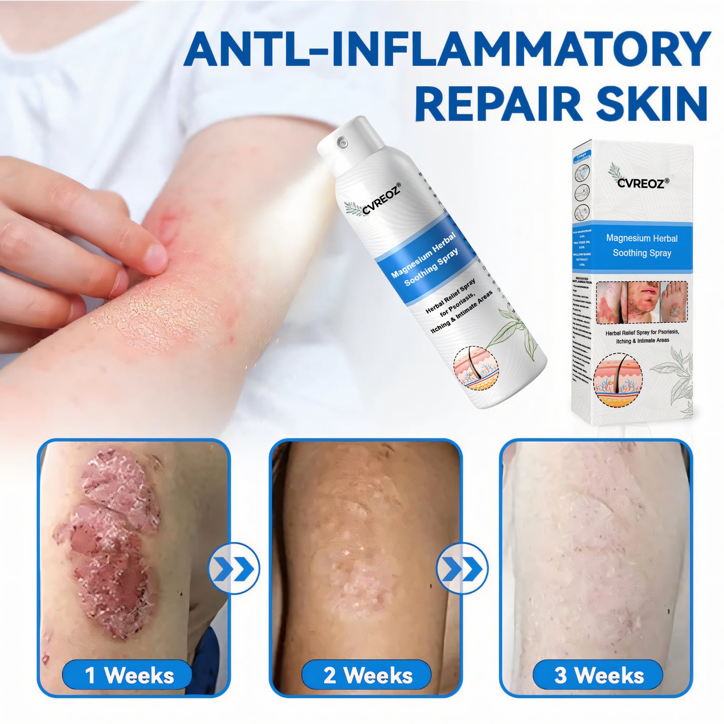Cvreoz® Magnesium Herbal Psoriasis Spray 👨⚕️ FDA Approved