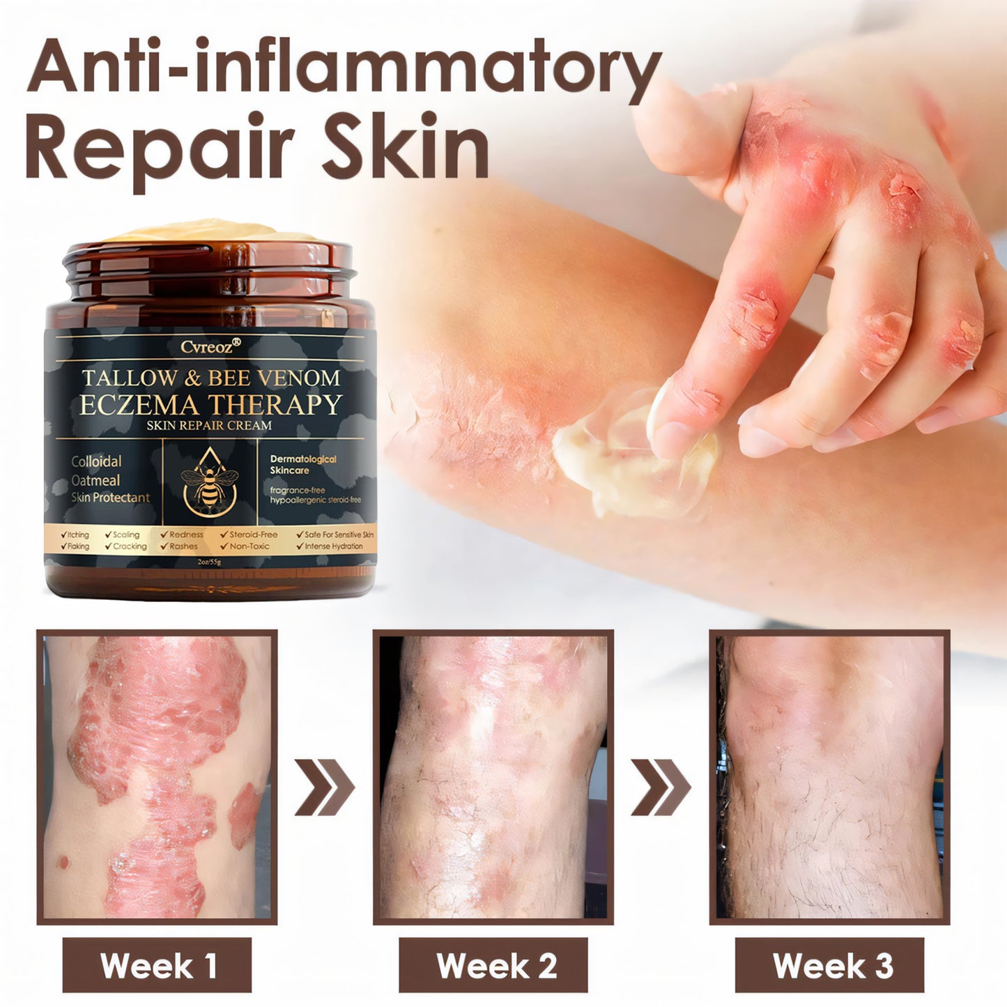 ⚡Final Chance: Save 60% Today Only🔥Cvreoz® Tallow & Bee Venom Eczema Theraphy