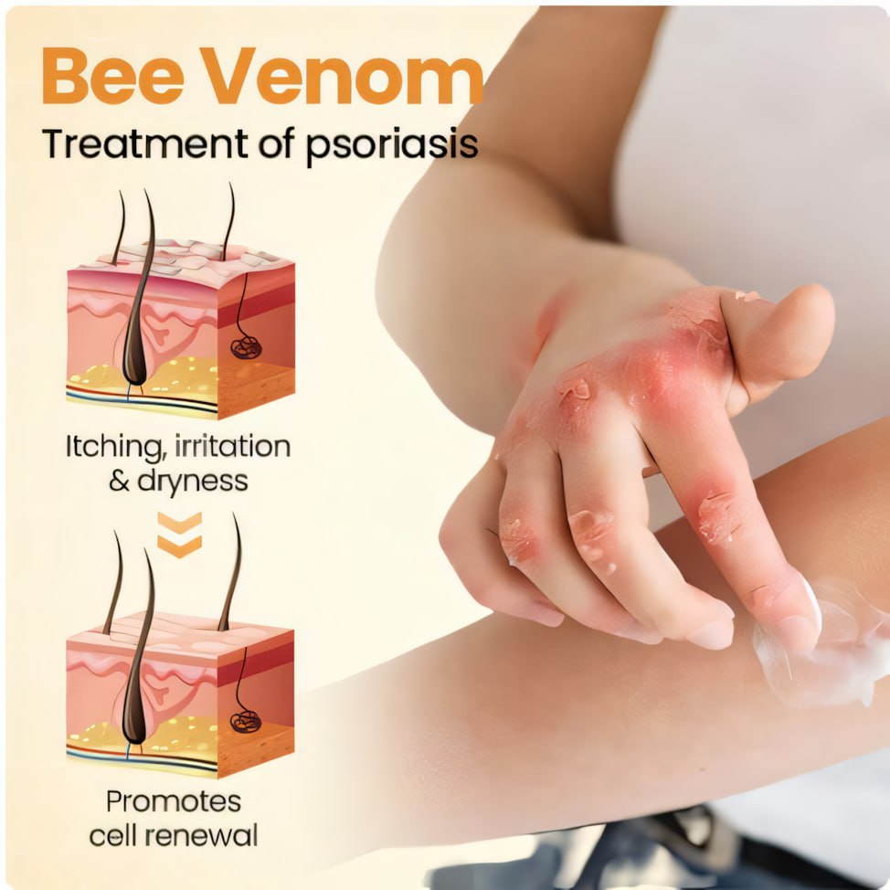 đ„ 60% OFF â CvreozÂź Beepure psoriasis Skin Care