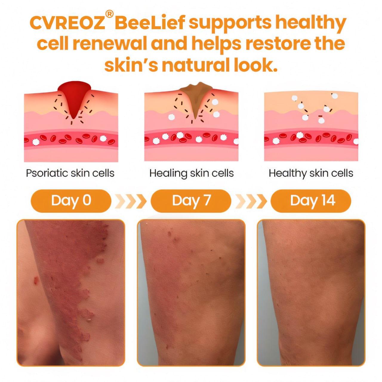 ⏰Last Day Promotion: 60% OFF🔥 Cvreoz® BeeLief Psoriasis Skin Care Cream