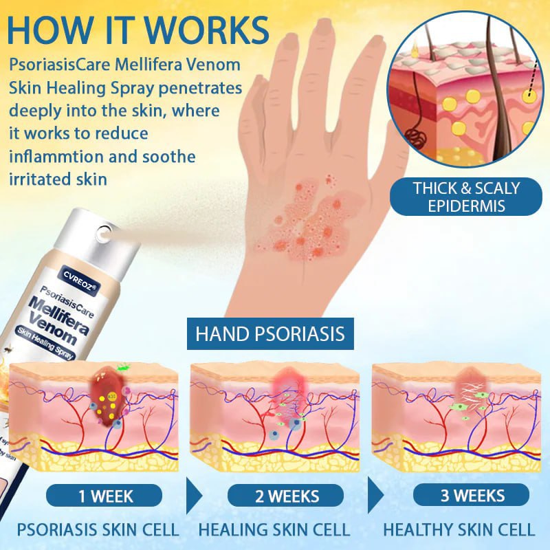 Cvreoz® PsoriasisCare Mellifera Venom Skin Healing Spray🔥