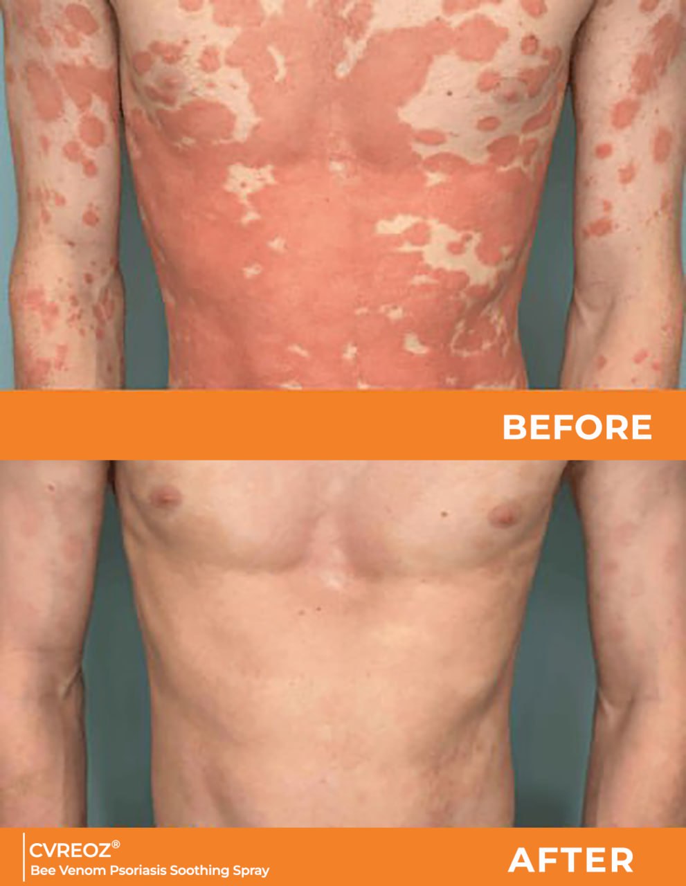 đ„CvreozÂź Bee Venom Psoriasis Soothing Spray đ LIMITED OFFER: 60% OFF đ„
