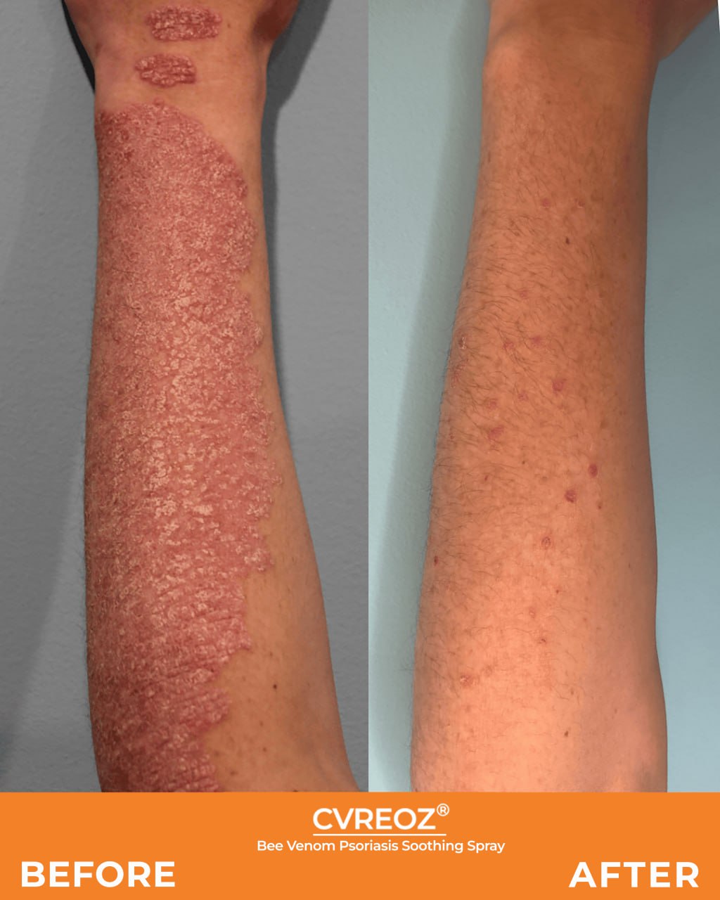 đ„CvreozÂź Bee Venom Psoriasis Soothing Spray đ LIMITED OFFER: 60% OFF đ„