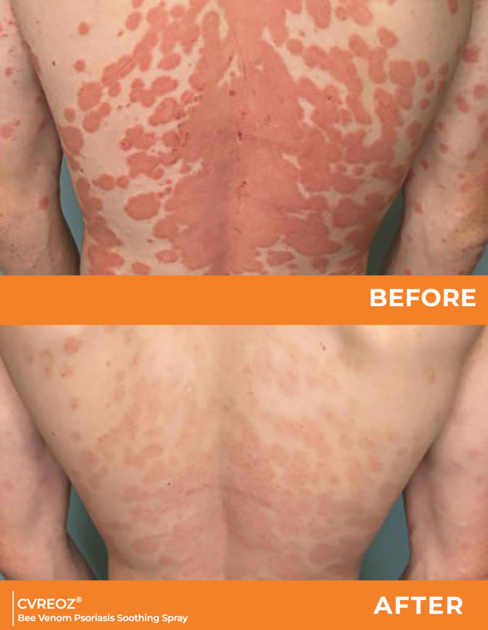 đ„CvreozÂź Bee Venom Psoriasis Soothing Spray đ LIMITED OFFER: 60% OFF đ„