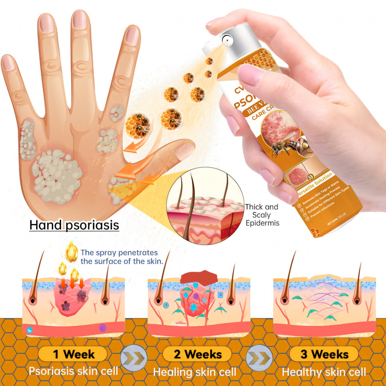 đ LIMITED OFFER 60% OFF đ CvreozÂź Psoriasis Bee Venom Care Spray