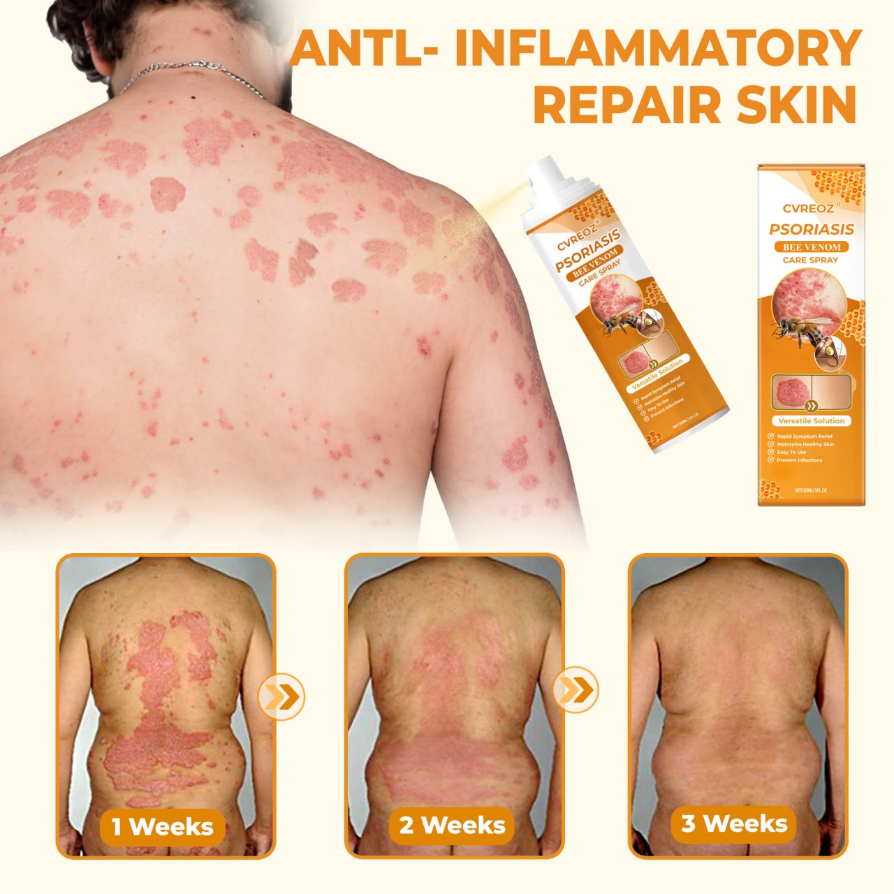 đ LIMITED OFFER 60% OFF đ CvreozÂź Psoriasis Bee Venom Care Spray