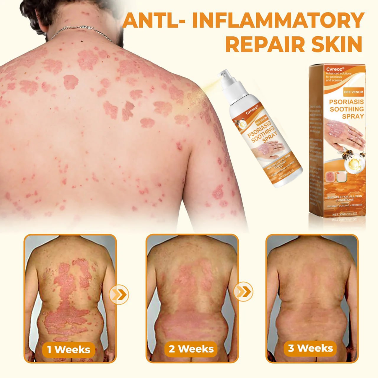 đ„CvreozÂź Bee Venom Psoriasis Soothing Spray đ LIMITED OFFER: 60% OFF đ„