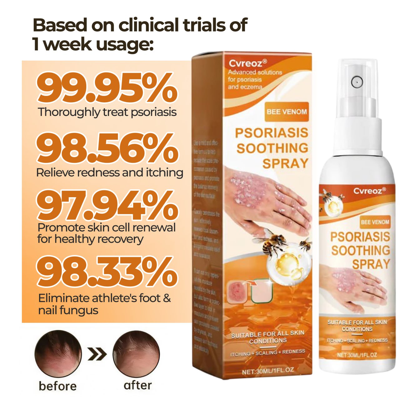 đ„CvreozÂź Bee Venom Psoriasis Soothing Spray đ LIMITED OFFER: 60% OFF đ„