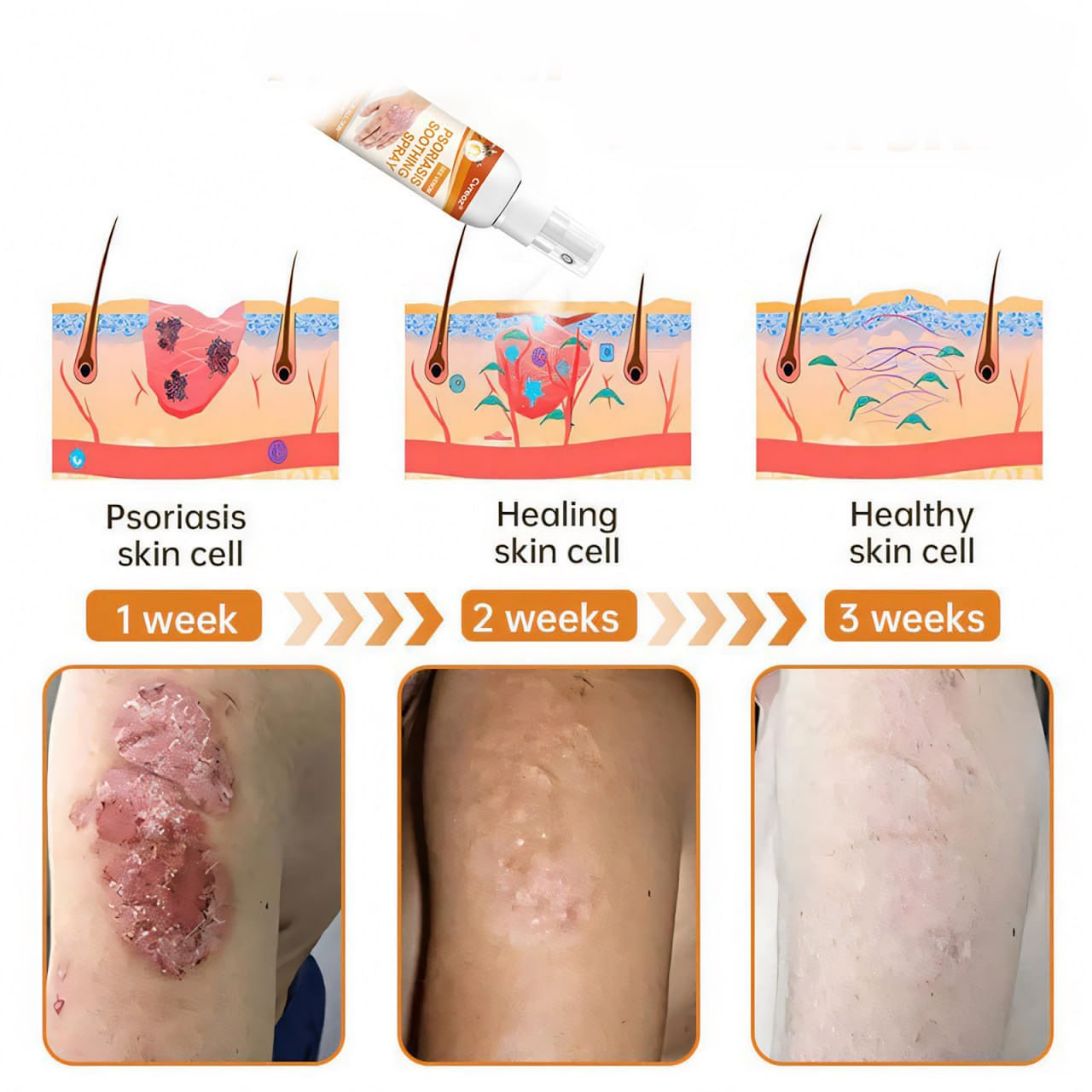 đ„CvreozÂź Bee Venom Psoriasis Soothing Spray đ LIMITED OFFER: 60% OFF đ„