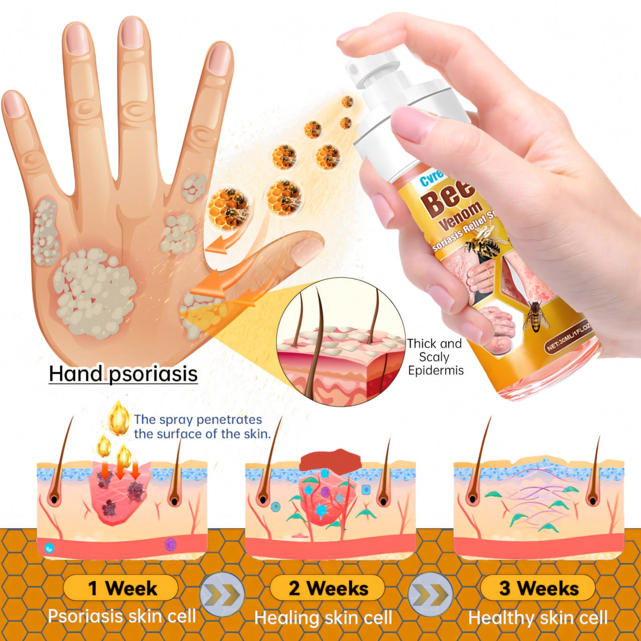 🐝 LIMITED OFFER 60% OFF 💛 Cvreoz® Bee Venom Psoriasis Relief Spray