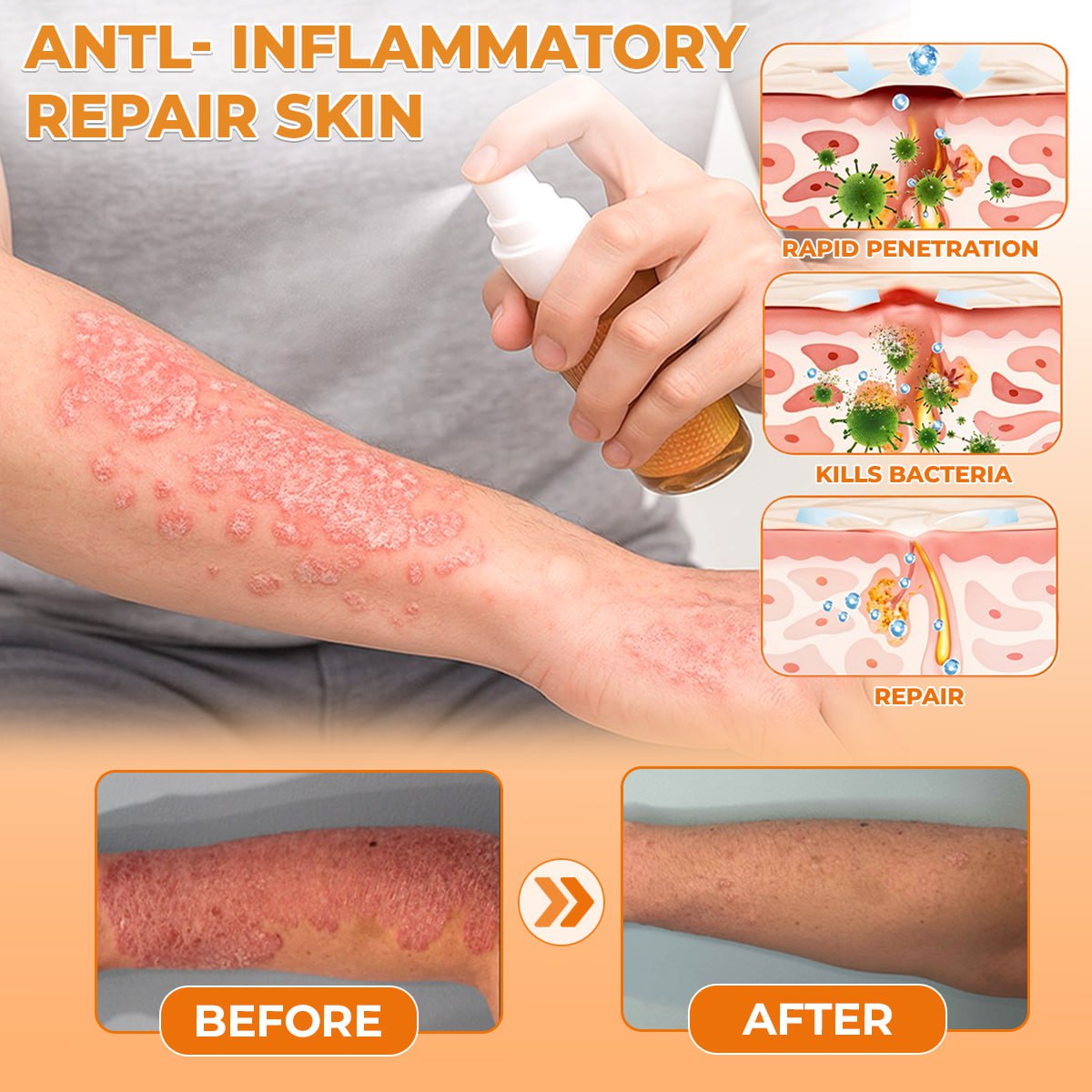 🐝 LIMITED OFFER 60% OFF 💛 Cvreoz® Bee Venom Psoriasis Relief Spray
