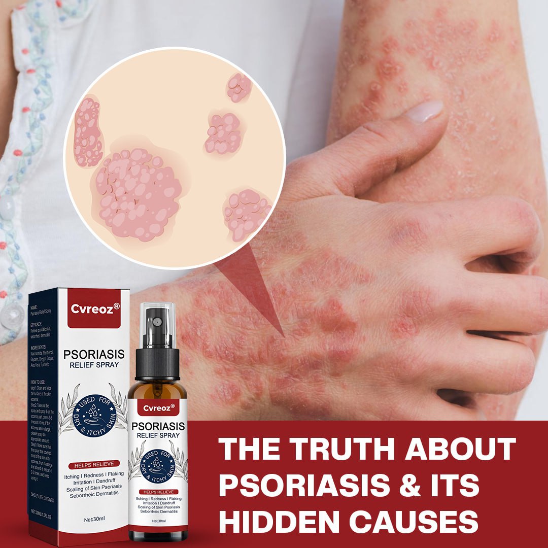 đ LIMITED OFFER: 60% OFF ONLY FOR TODAY đ CvreozÂź DermSoothe Psoriasis Relief Spray